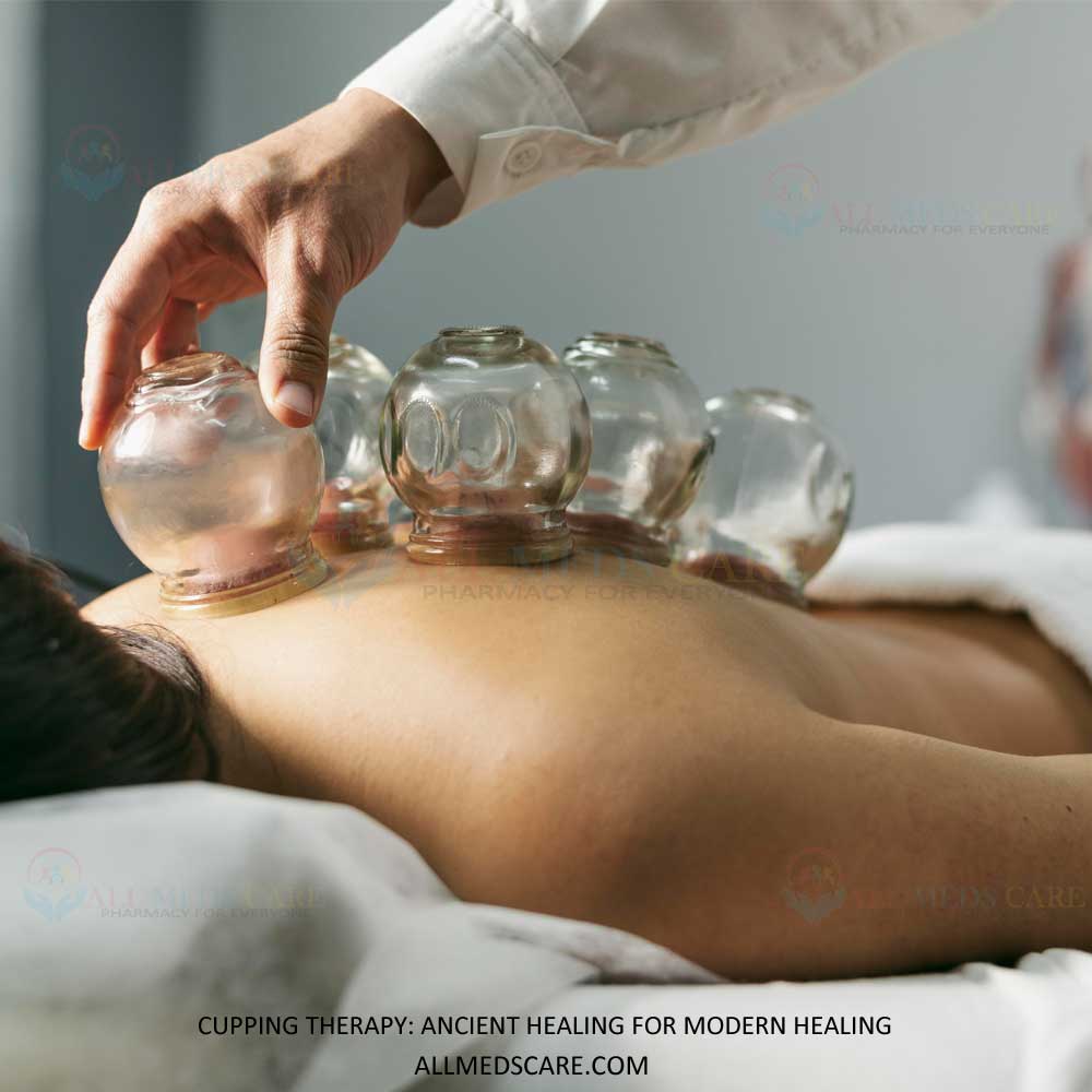 Cupping Therapy: Ancient Healing for Modern Wellness
