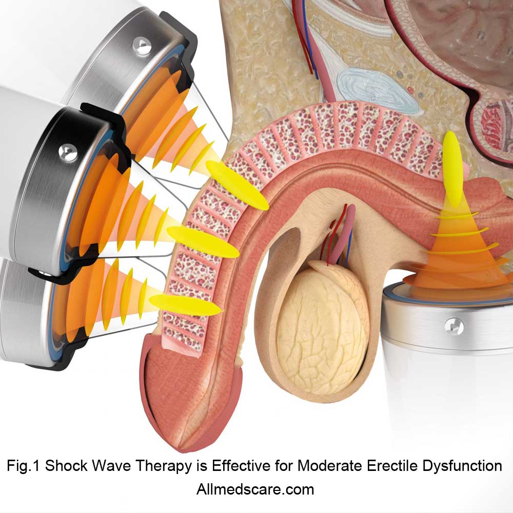 Shock Wave Therapy for Erectile Dysfunction - Allmedscare.com